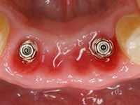 adin_implant_placement_flap_method_small