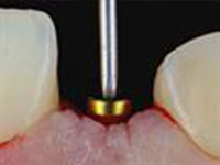 endodontics-restorative